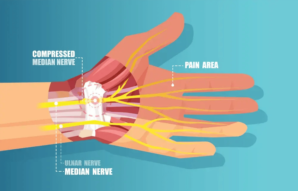 Graphic showing compressed nerve in the wrist which causes Carpal Tunnel Syndrome