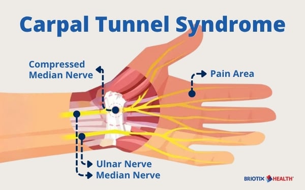 Graphic showing the wrist carpal tunnel (1)